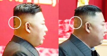 কিমের মাথায় ব্যান্ডেজ কেন?