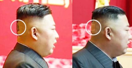 কিমের মাথায় ব্যান্ডেজ কেন?